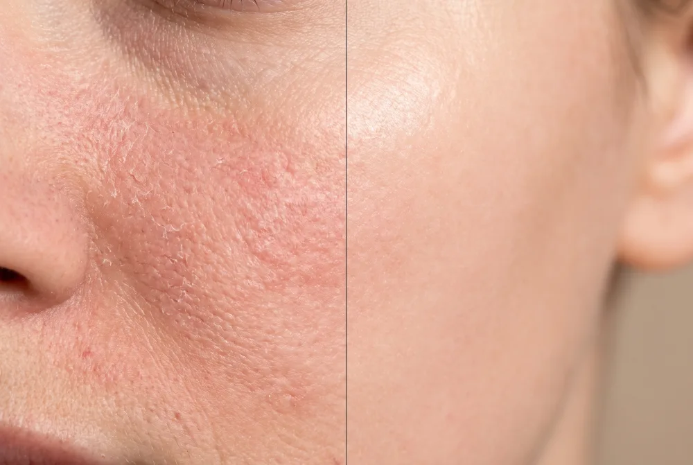 Skin before and after - the difference in texture and redness