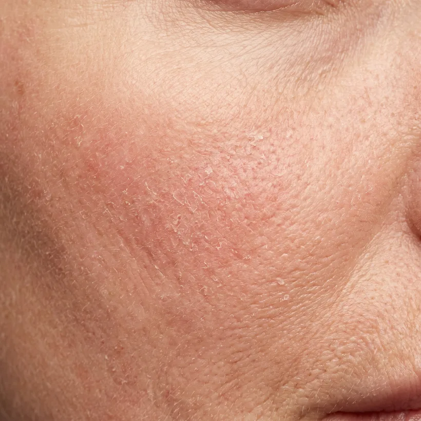 Close-up of dry, flaking, reddened skin